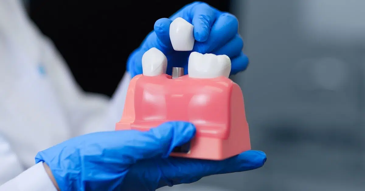 Essential facts about dental implants