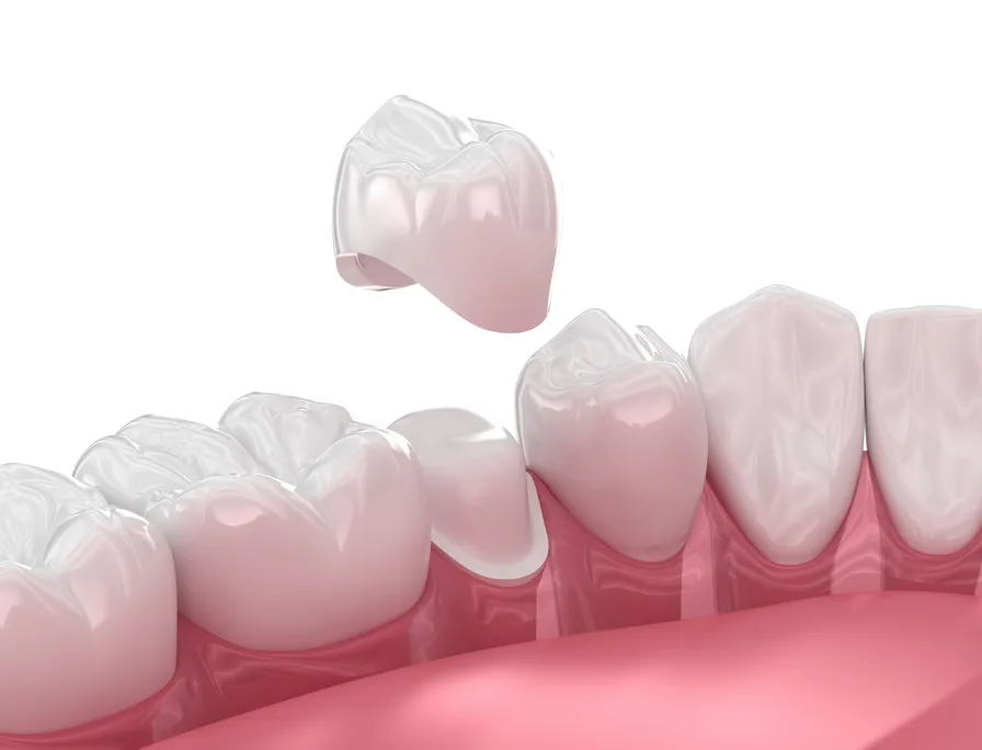 3d render of a Same day crown