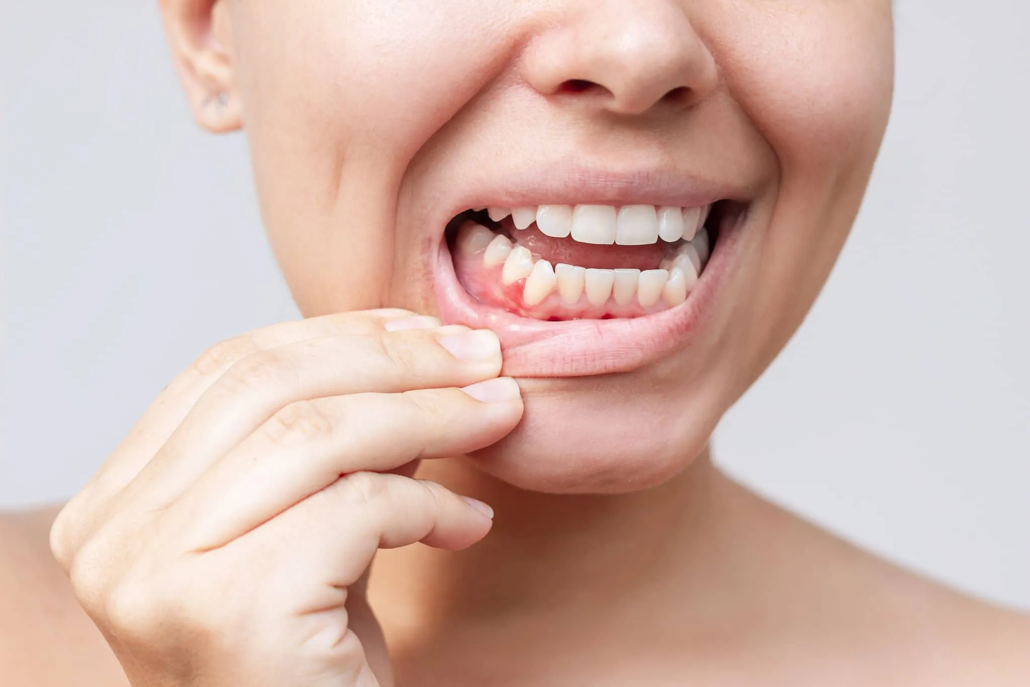 women pulling back lips to show gum and crooked misaligned teeth