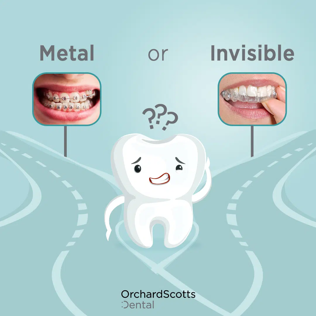Metal braces or clear aligners: weighing the trade-offs