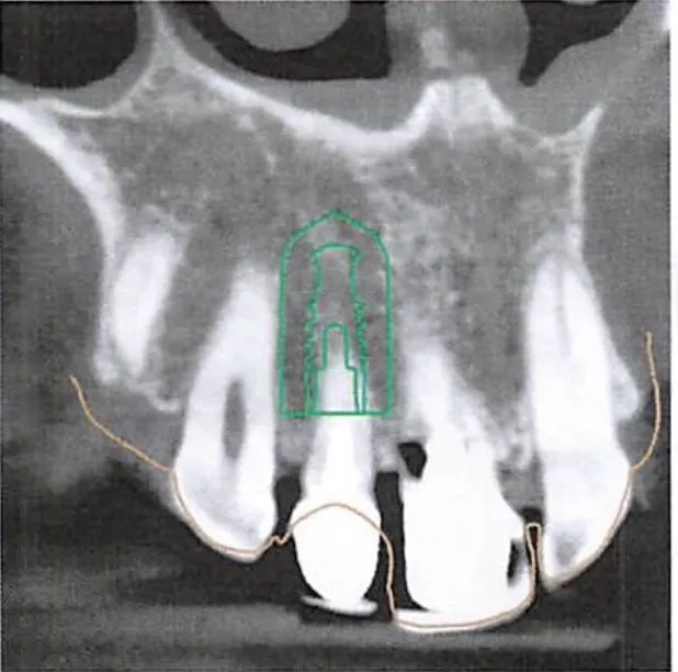 Dental X-ray showing upper teeth roots with a green digital overlay of an implant placement.