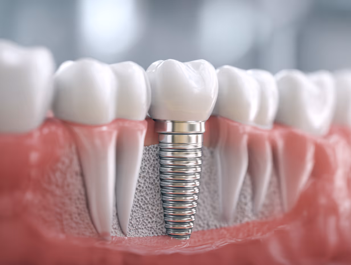 Close-up of a dental implant with a metal screw inserted into the jawbone and a white crown on top, surrounded by natural teeth and gums.
