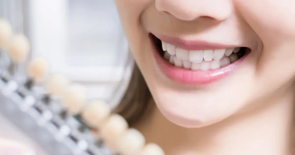 closeup women smiling shade match teeth