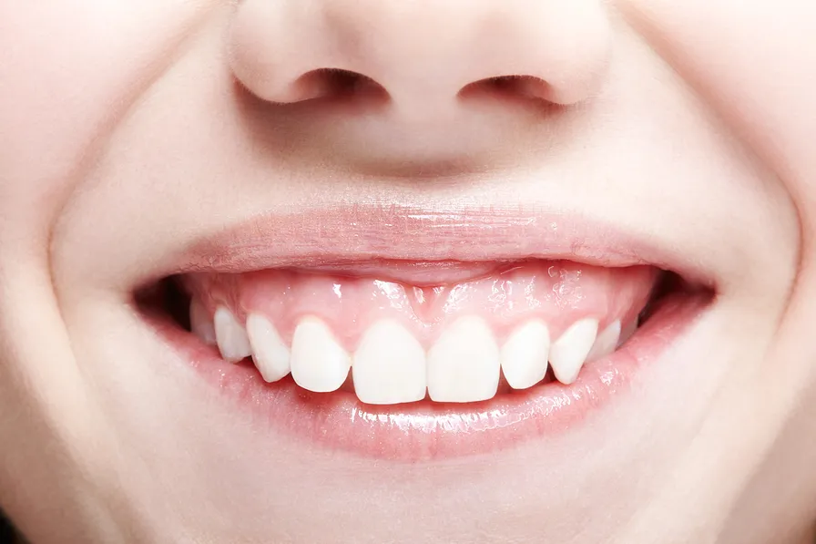 Closeup of a woman with gummy smile